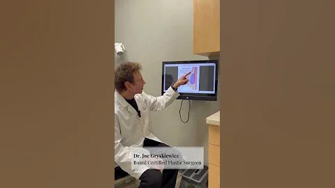 Breast Implant Placement... Over or Under the muscle? #breastaugmentation #breastimplants