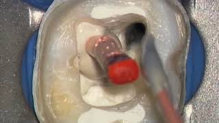 Shape Clean Pack: 3D Obturation - Vertical Compaction Clinical Op: Dr. Ruddle Advanced Endodontics