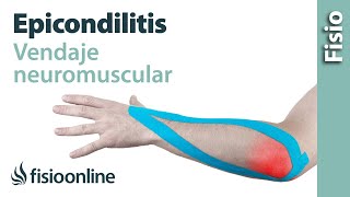 Epicondilitis o codo de tenista. Tecnica de vendaje neuromuscular o Kinesiostape.