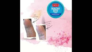 Healthy Feet Cream Before & After
