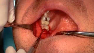17 Tuberplastik
