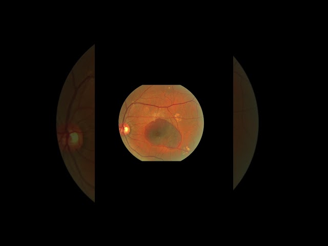 Are supplements beneficial for macular degeneration?