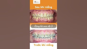 Hành trình LỘT XÁC nhờ niềng răng của Trà My