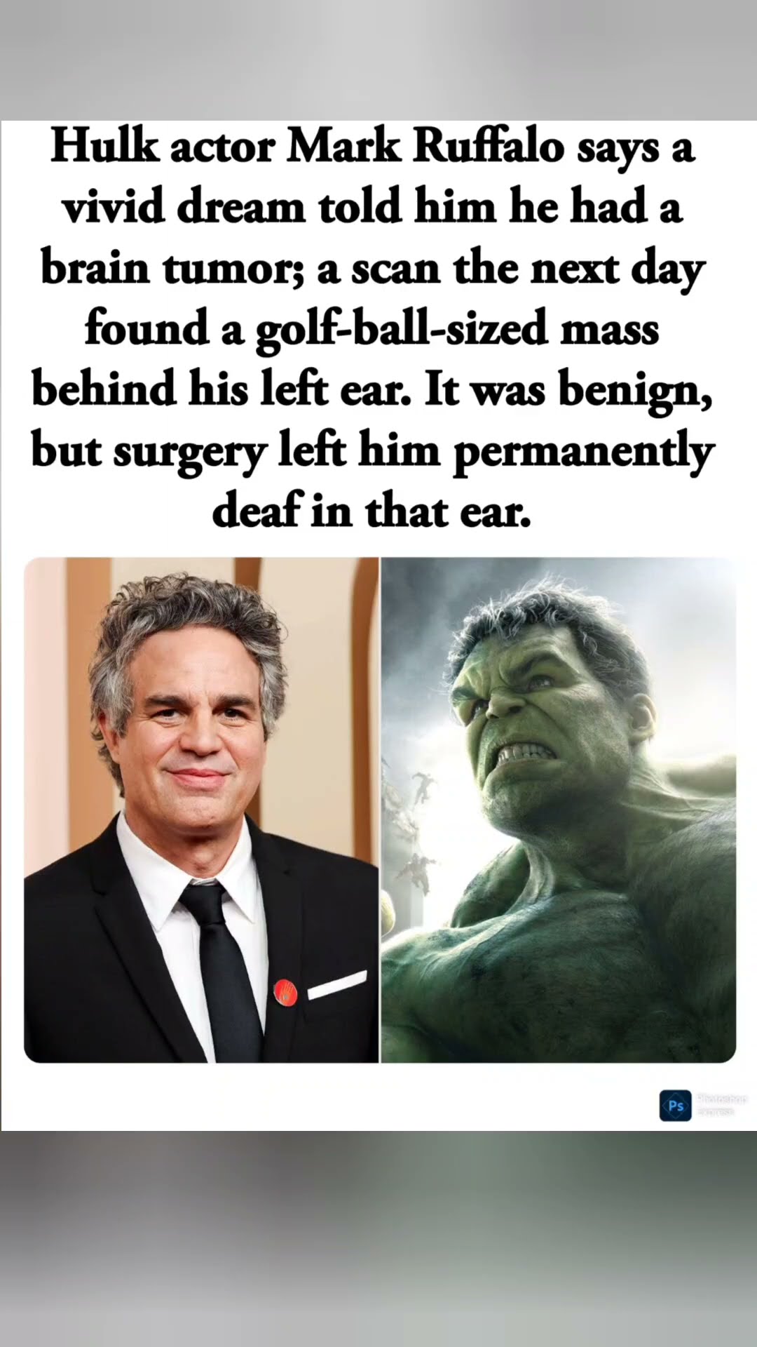 Mark Ruffalo’s Dream Led to Brain Tumor Diagnosis And Permanent Deafness#sad #vilar #america
