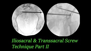 Pelvic Ring Injury: Iliosacral & Transsacral Screw Technique Explained Part II