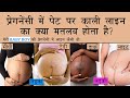प्रेगनेंसी में पेट पर काली लाइन का मतलब Pregnancy me pet par line kab aur kyu banti hai| Linea Nigra
