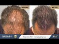 How Does Scalp Micropigmentation (SMP) Work?