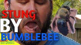 Stung by bumble bee and carpenter bee 