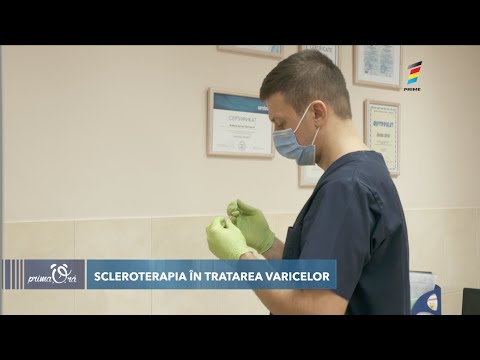 SCLEROTERAPIA - O PROCEDURĂ CARE NE SCAPĂ DE VARICE. SFATURILE MEDICULUI.