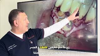 Apicectomy of lower anterior teeth