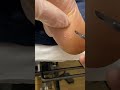 Expert australian podiatrist removes painful corns with precision