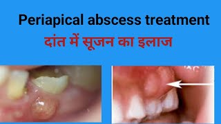 मसड क सजन क इलजदत क नच फड हन क इलजदत पस बनन Periapical Abscess
