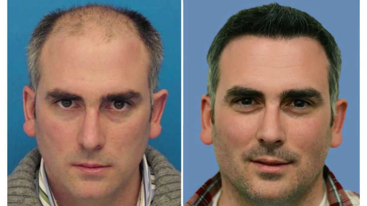 Hair Transplant | Incredible Hair Transplant Surgery Results!