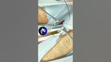 See how an Extensor Tendon Injury (Zone 4) is surgically repaired in 4K 3D animation.