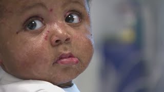 Topical treatment trial offers hope for kids with rare skin disease