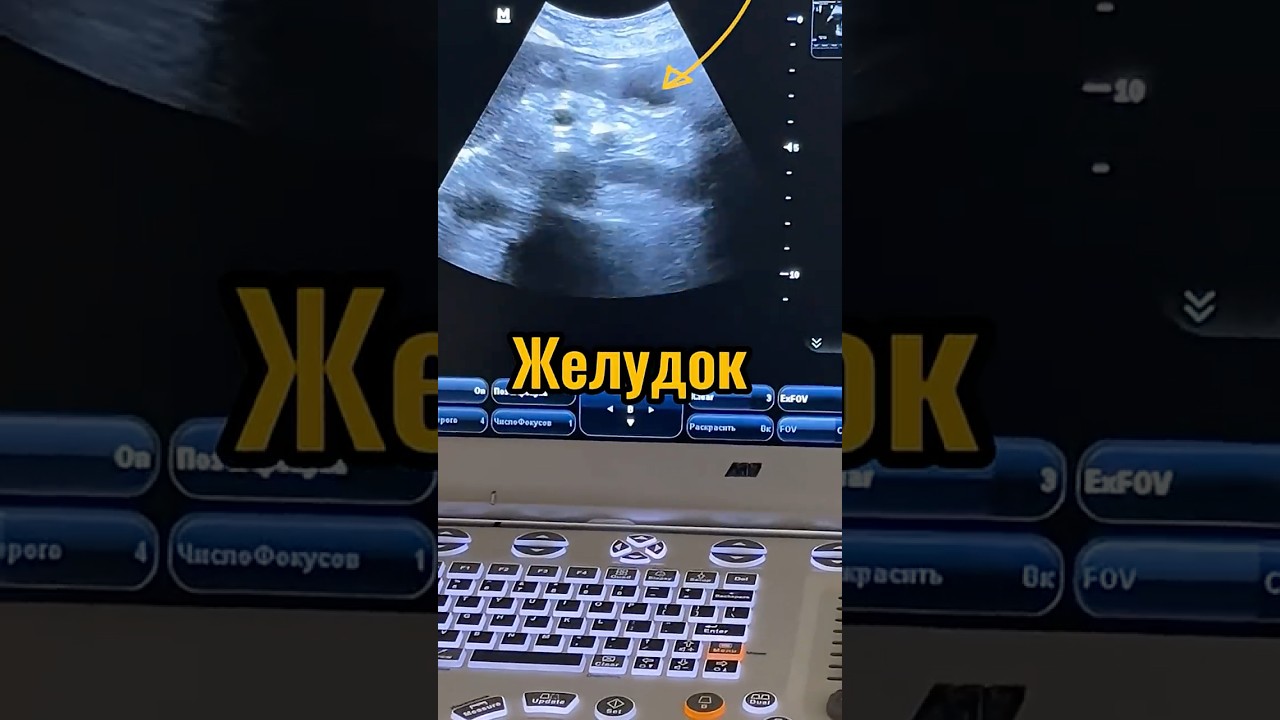 УЗИ ЖЕЛУДКА И ОЦЕНКА РИСКА АСПИРАЦИИ #icu #icucare #anesthesiology #ultrasound #gaster
