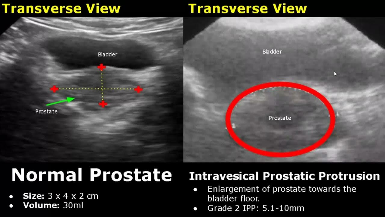prostate-ultrasound-normal-vs-abnormal-image-appearances-transrectal