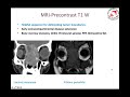 Imaging of PNS and anterior skull base tumors: Dr Amit Janu