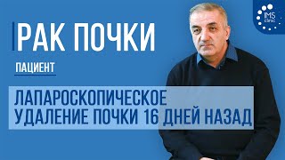 Рак почки. Лапароскопическое удаление почки 16 дней назад