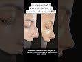 #NoseCorrection#DeviatedNoseSurgery#NoseReshaping#NoseSurgery#skincare #NoseJob