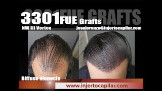 3301FUE Grafts. NW IIIvertex. Thin/Diffuse. Best outcome in 1 procedure.Injertocapilar.com.2643/2021