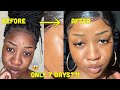 HOW I CLEARED MY SKIN in 1 WEEK!!!! and LIGHTENED my dark under eye circles