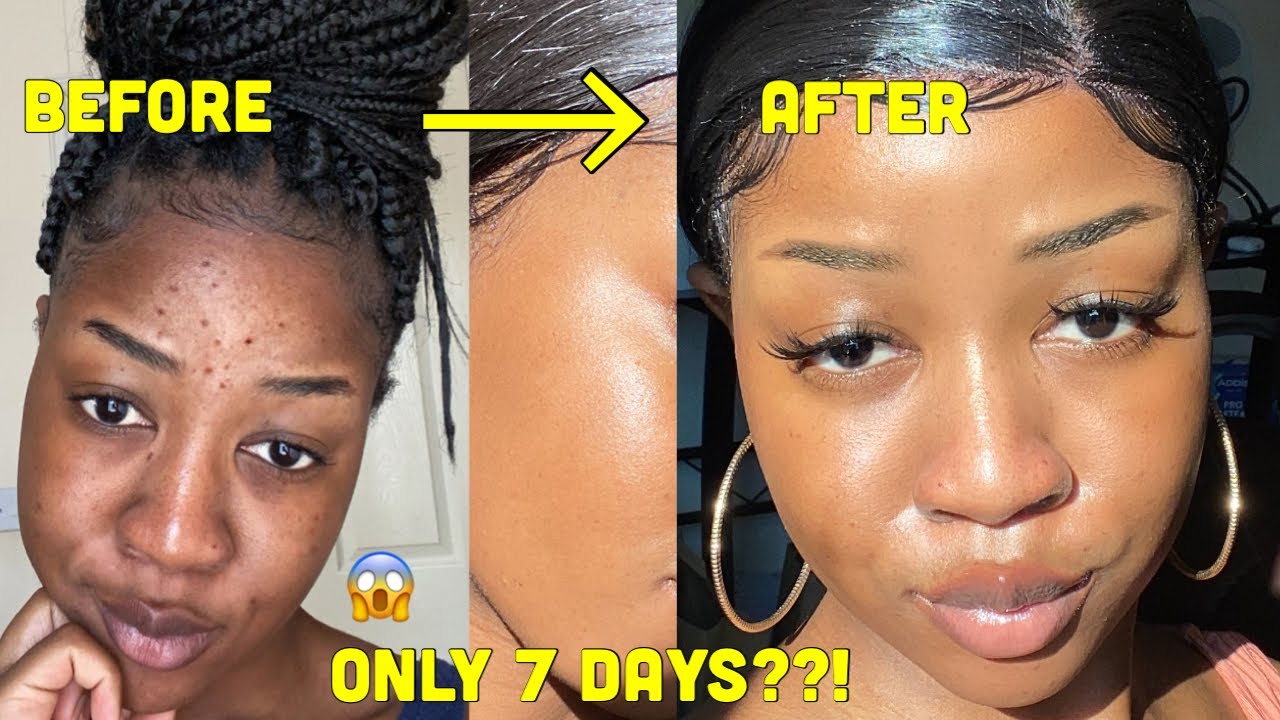 HOW I CLEARED MY SKIN in 1 WEEK!!!! and LIGHTENED my dark under eye circles