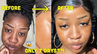 HOW I CLEARED MY SKIN in 1 WEEK!!!! and LIGHTENED my dark under eye circles