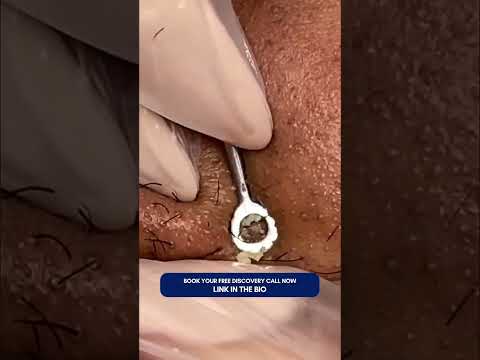 Gross Skin Gunk EXTRACTIONS (PART 3)