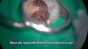 17938 broken file removal with a single TFRK S