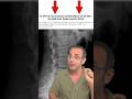 Hernia discal, protusión, degeneración discal #fisioterapia #salud #yoga #shorts #dolorlumbar