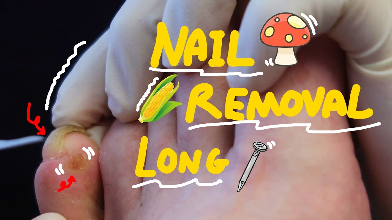 Corn removal + FULL NAIL TREATMENT with a dash of Fungal nail YouTube