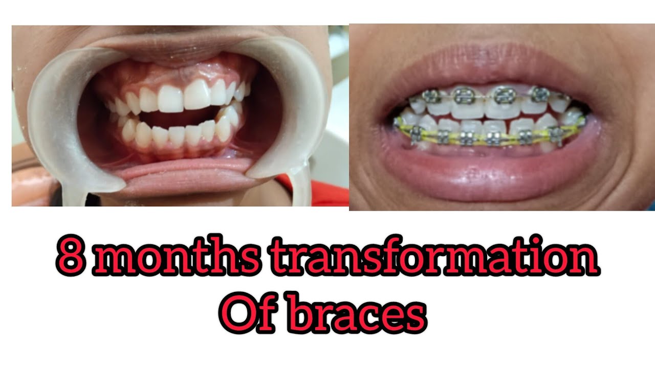 8 months transformation of braces 4th tightening update ️ YouTube