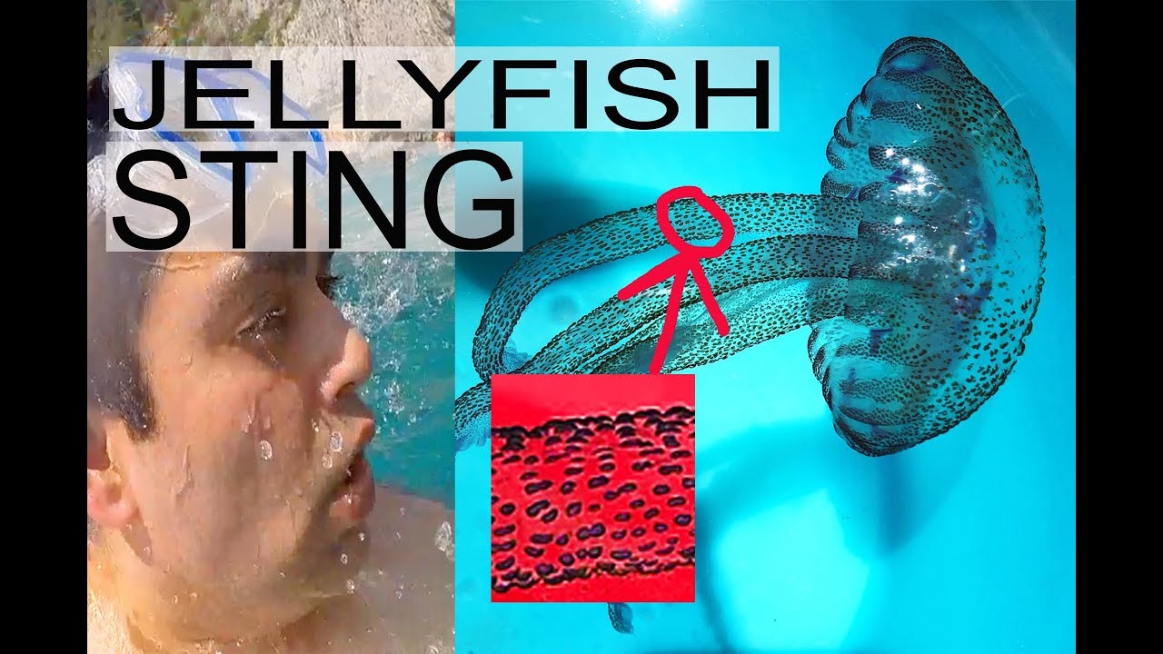 CAUGHT on TAPE Jellyfish sting in POSITANO ITALY JELLYFISH STING