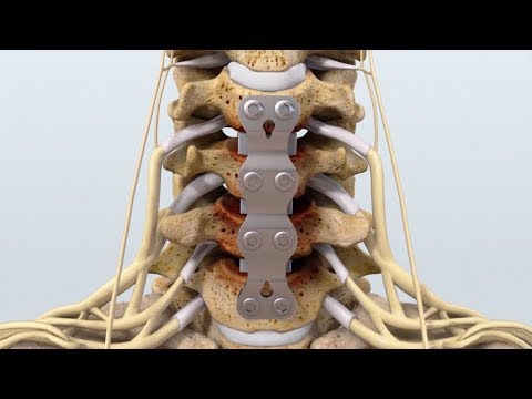 $650K Result: Animated C4-7 Anterior Cervical Discectomy with Fusion