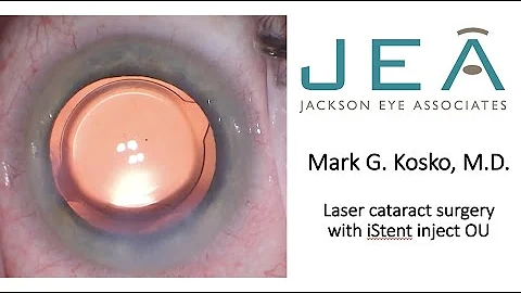 laser cataract surgery istent inject OU Kosko