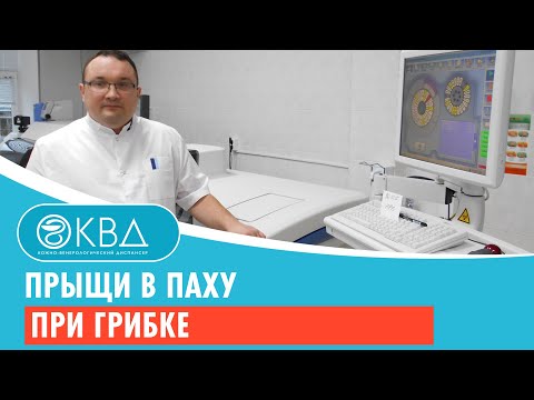 😕 Прыщи в паху при грибке. Клинический случай №981