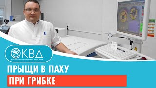  Прыщи в паху при грибке Клинический случай 981