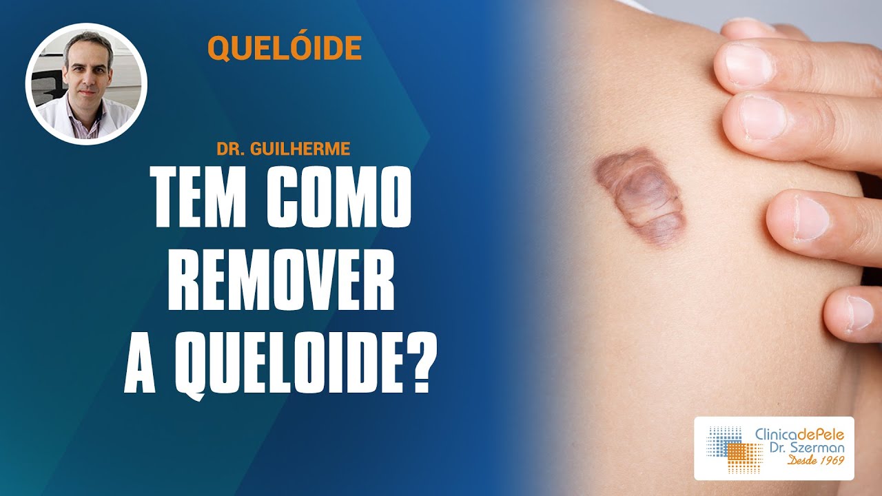Queloide [Conheça o Melhor Tratamento] - YouTube