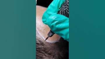 2nd month Treatment-Scalp Micro Pigmentation    #scalpmicropigmentation #hairlosssolution