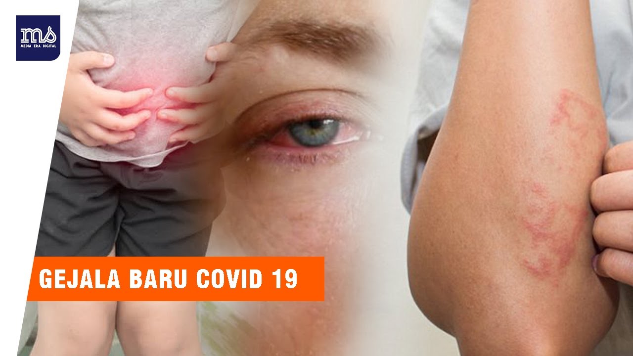 Gatal Gatal Mata Merah Waspada Gejala Baru Virus Corona Youtube