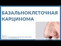 Что такое  базально-клеточная карцинома? | Cancer Education and Research Institute (CERI)