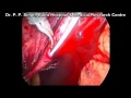 Retrocaval ureter