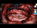 Surgery for brainstem cavernous malformations by michael lawton md  neurosurgical tv