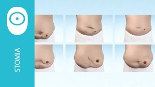 Coloplast BodyCheck