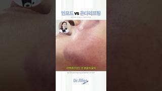 #shorts 인모드 vs 온다리프팅 효과, 차이점 Inmode vs Onda Lifting