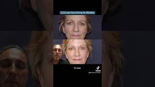 CO2 Laser Resurfacing For Wrinkles