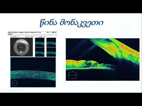 ნინო კობახიძე - OCT  და კომპიუტერული პერიმეტრია გლაუკომის დიაგნოსტიკისა და მონიტორინგისთვის