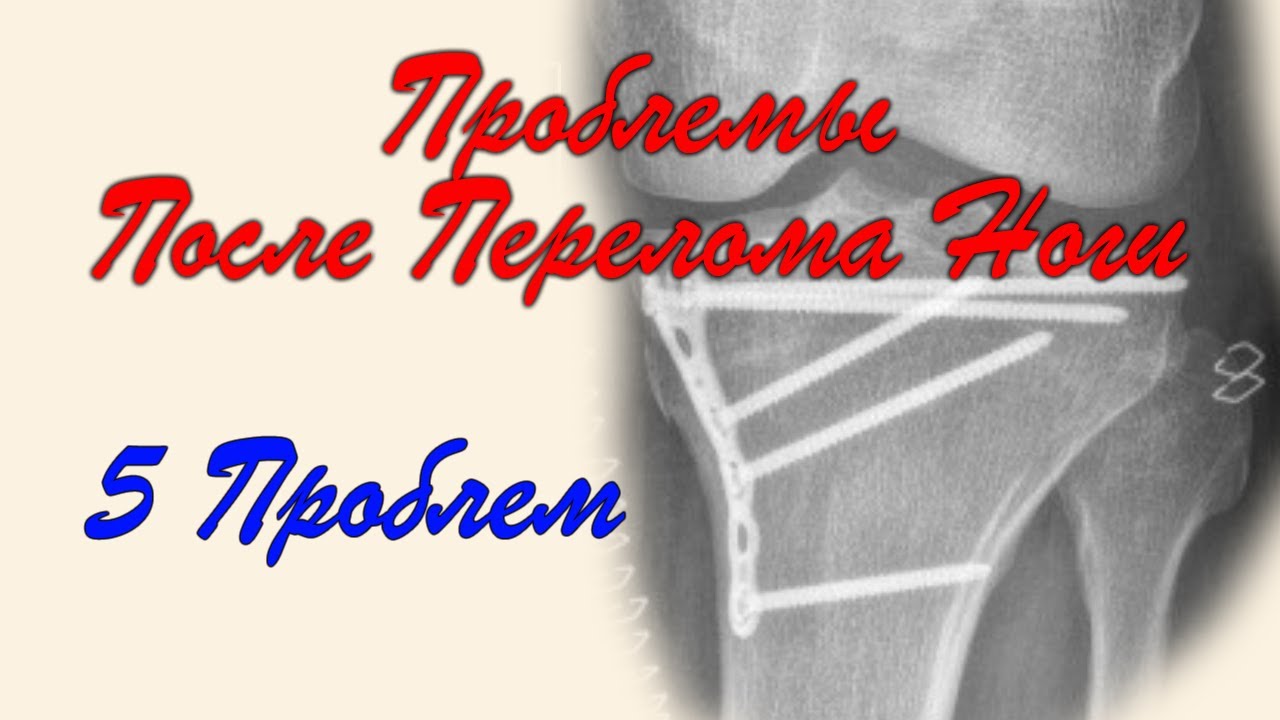 Перелом Большеберцовой Кости. Проблемы после перелома ноги. 7 Месяцев спустя.