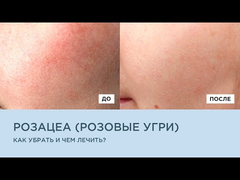 РОЗАЦЕА. РОЗОВЫЕ УГРИ. Как убрать чем лечить?